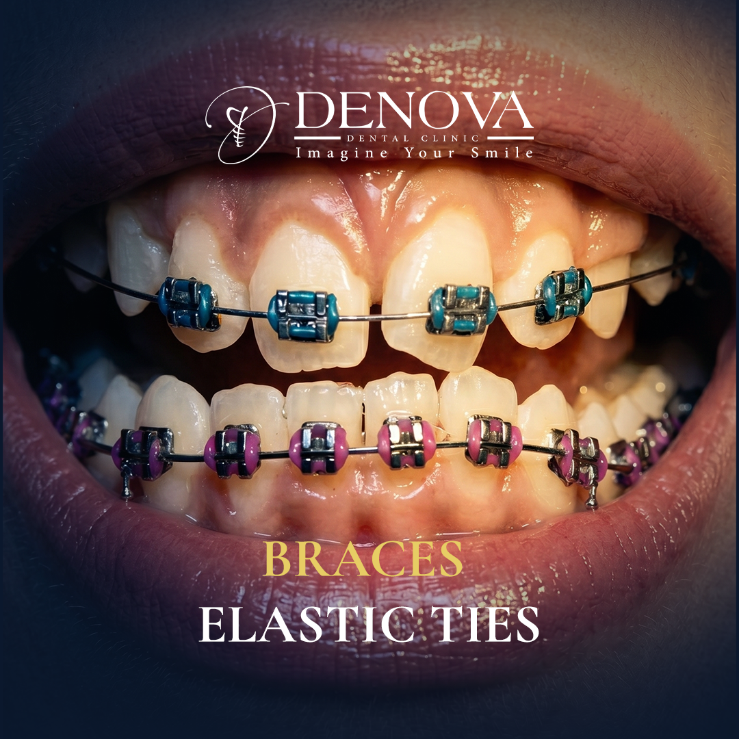 Orthodontic Braces