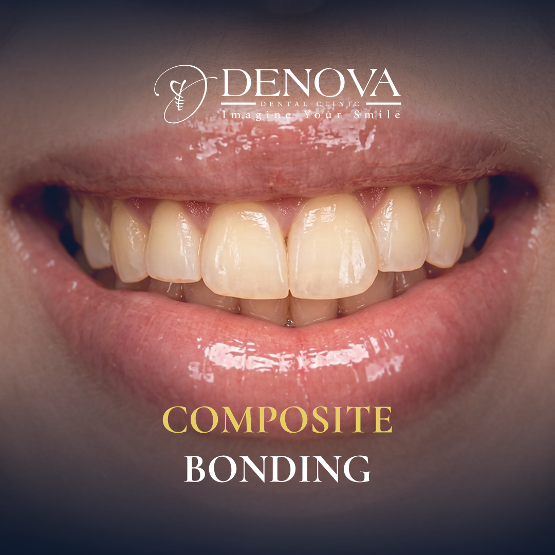 Composite Bonding