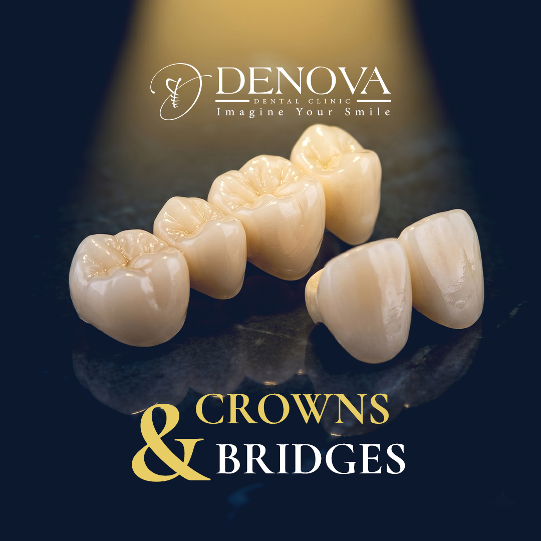 Crowns & Bridges